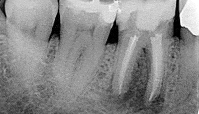 endodontische spoedbehandeling