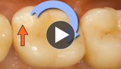 Implantaat restauraties met minder complicaties Implantaat restauraties met minder complicaties