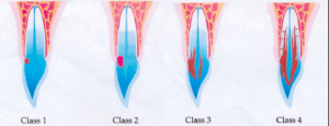 Classificatie ICR volgens Heithersay, klasse 1 tm 4