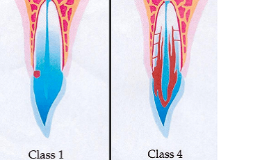 Classificatie ICR volgens Heithersay