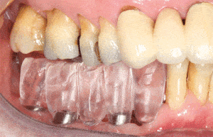 Prematuur-contact-in-het-4e-kwadrant---Elysee-dental-7