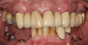 bonelevel-implantaten---Elysee-Dental-2