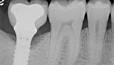 Peri implantitis