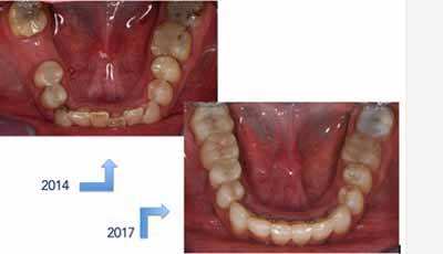 Dahlframes, orthodontie en een ‘restricted envelope of function’