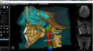 Airway Analysis