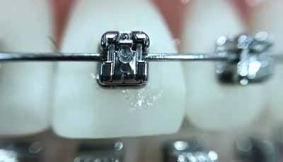 stem gereedschap Verdeelstuk Hechtende lijm voor beugels voor betere bescherming gebit - dental INFO