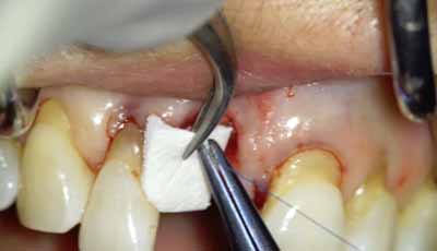 Herstel van een alveolair defect