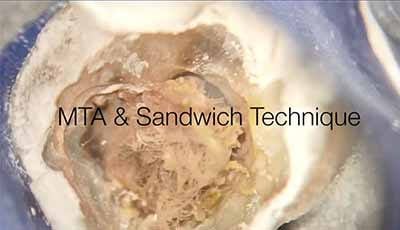 Video: Sandwich methode herstellen perforatie in de 46