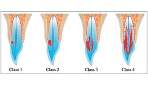 Externe cervicale resorptie (ECR)