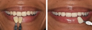 Helderheid-over-whitening-1.-en-2-pg