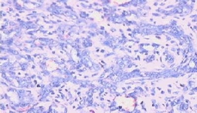 Casus-parodontitisklachten-blijken-door-kwaadaardige-tumor-veroorzaakt-te-zijn