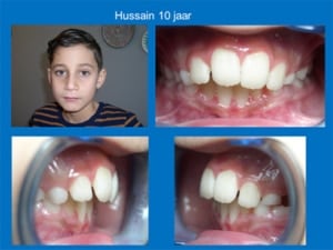 Casus-3-Hussain-10-jaar