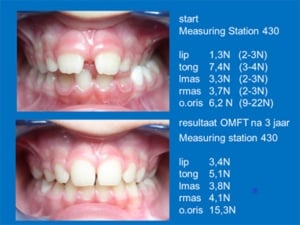 Resultaat-Slik-en-myobrace