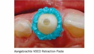 VOCO-retraction paste