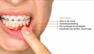Dynexan® mondgel