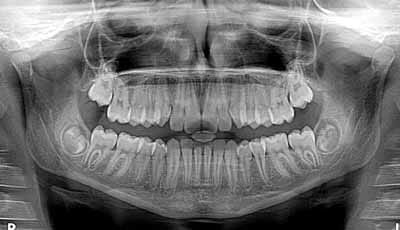 Röntgenfoto’s schieten tekort bij diagnosticeren cariës bij kleuters