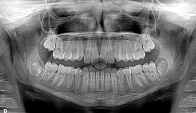 Stralingshygiëne voor gebruik van CBCT