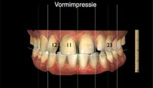 Casus: Bovenfront esthetiek zonder ortho, soms is het eenvoudiger dan het lijkt....