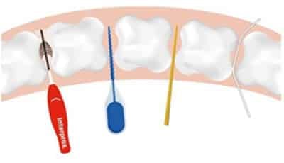 Geruïneerd Gronden draadloze Effectief reinigen van de interdentale ruimten - dental INFO