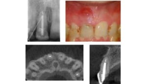 Redenen extractie endodontisch behandelde elementen