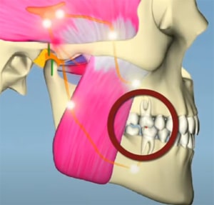 7. Neuromusculaire sturing ten gevolge van een prematuur contact. 