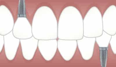 Zijn implantaten gedoemd om te mislukken