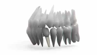 Cantileverconstructies op implantaten